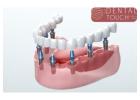 Restore Your Smile with Dental Implants in Leesburg