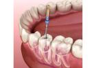 Best Root Canal Specialists in Latur – Book Now!