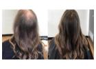 Hair Regrowth Treatment Birmingham UK