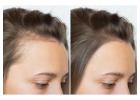 Micro scalp micropigmentation – The Art of Looking Effortlessly Complete!