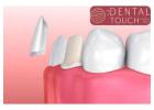 Enhance Your Smile with Veneers in Leesburg