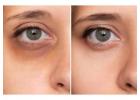 Erase Tired Eyes: Experience Our Under Eye Peel