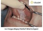 Tongue Biopsy: A Quick, Painless Procedure for Early Diagnosis