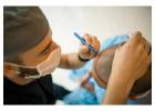 What is the best age for hair transplant?