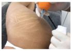 Where to Find Effective Stretch Mark Treatment in London?