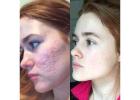 Advanced Acne Laser Treatment for Smooth, Clear Skin