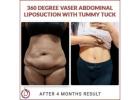 Transform Your Body with the Best Tummy Tuck Surgery in India!