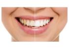 Brighten Your Smile with Teeth Whitening in Santa Clara