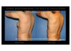 Sculpt Your Chest with Gynecomastia Surgery New York