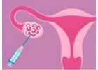 Varicocele Surgery Procedure | Varicocelectomy | AEVA Clinic