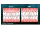 Get a Perfect Smile with Same-Day Crowns in Las Vegas!
