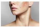 Clear Skin Starts Here: Advanced Acne Scars Treatment in Kolkata – Only at Image Clinic