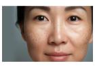Effective Melasma Treatment in Delhi near me - Delhi Wellness Clinics