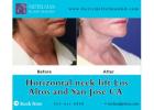 Horizontal neck lift Los Altos CA to tighten sagging skin