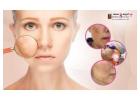 Effective Laser Treatment for Pigmentation in Bangalore