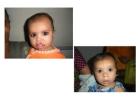 Title: Cleft Lip and Palate Surgery: Restoring Smiles and Confidence